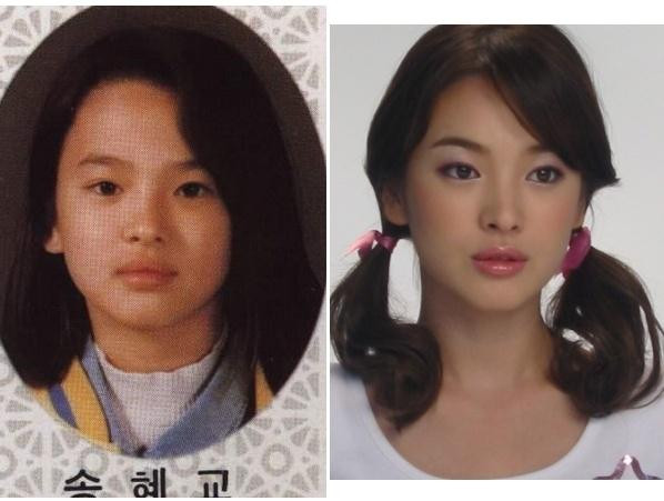 vietnamese plastic surgery before and after