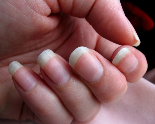 what-are-the-symptoms-of-yellowing-of-fingernails-and-toenails